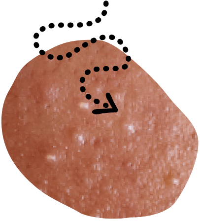 Pimples on Skin
